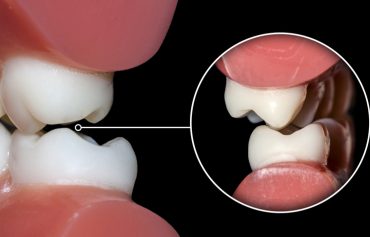 Diş Gıcırdatma Tedavisi